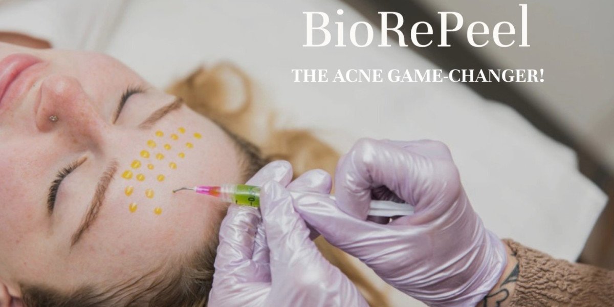 How BioRePeel Helps Clear Acne Without Harsh Peeling