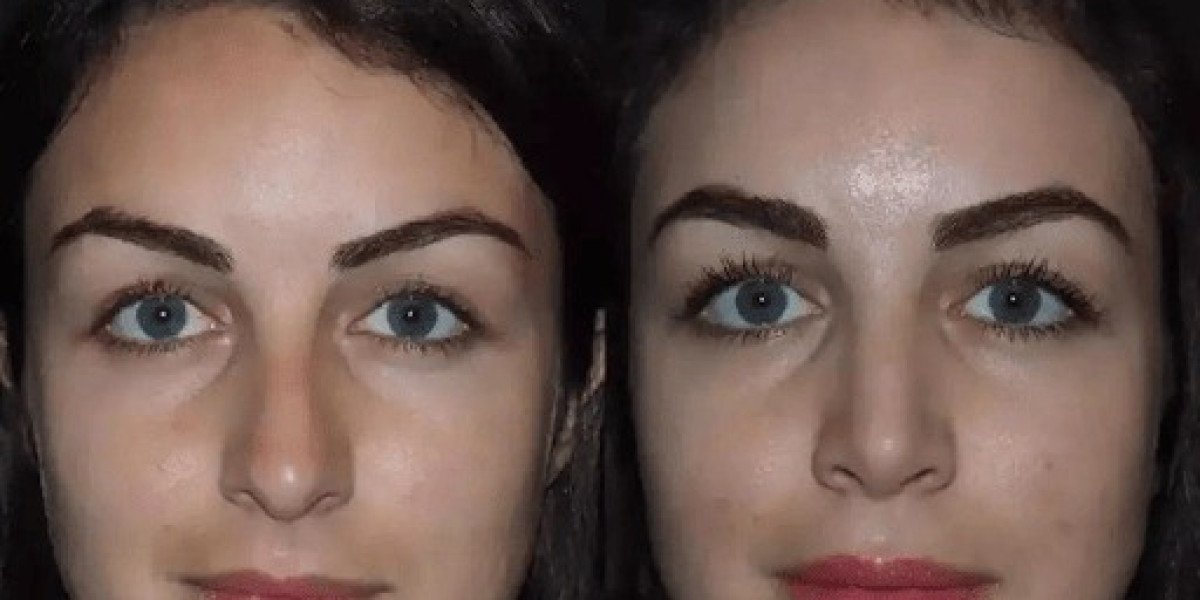 Rhinoplasty in Dubai: Expert Recommendations for Prospective Patients