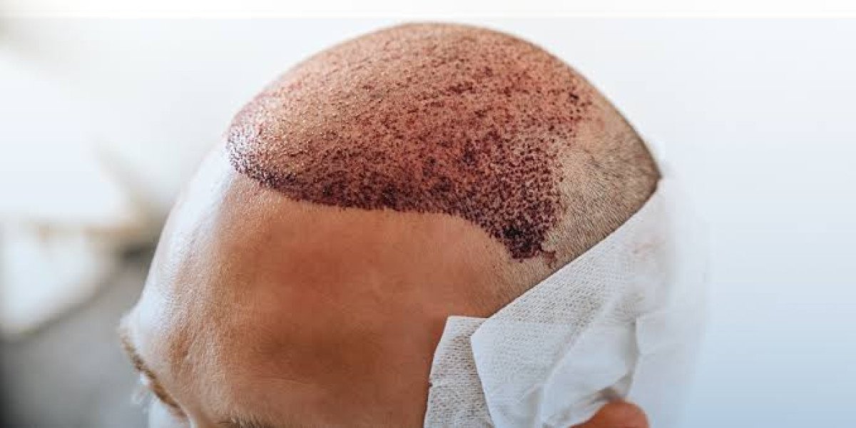 Preparing for Hair Transplant Recovery in Dubai